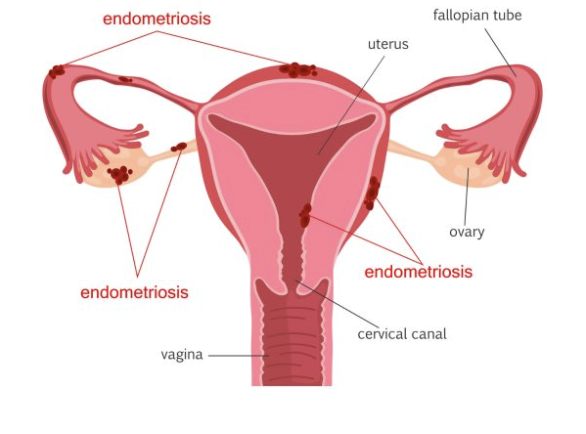 Endometriosis Treatment - Specialist Gynaecology Treatment at First Care Clinic