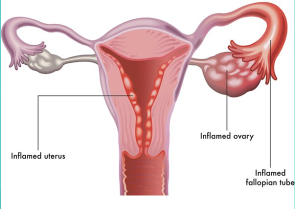 PCOS / PCOD - Specialist Gynaecology Treatment at First Care Clinic
